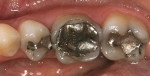 Figure 3  Preoperative image of posterior teeth requiring restoration.