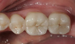 Figure 4  Image of bonded CEREC Vitabloc Mark II restorations.