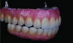Fig 25. The restoration is layered to completion with the desired ceramic overlay material.