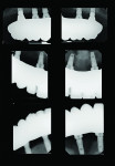 Fig 26. The final full-mouth restoration
is inserted.