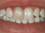 Figure 5  Preoperative view of a case with a leaking and discolored veneer on tooth No. 8.