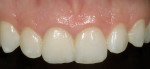 Figure 6  Postoperative view of a conventional veneer tooth on tooth No. 8 and a minimal preparation veneer on tooth No. 9 made with VM13 (Vita/Vident).