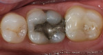 Figure 8  Preoperative view of teeth requiring restorations.