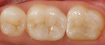 Figure 9  Postoperative view of a full onlay on tooth No. 30 and an inlay on tooth No. 31 made from a full-contour machining of e.max CAD.