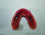 Fig 3. With the upper bars in the mouth,
a final impression is taken inside the existing upper denture.
