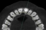 The axial slice revealing the gutta-percha fill within the maxillary left central incisor.