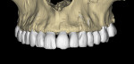 A CBCT 3D-reconstructed volume of a patient’s maxillary arch.