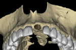 Using advanced software features, the existing tooth can be virtually extracted.