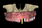 The modified stone cast merged to the CBCT dataset with implant projection.