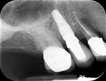 Fig 9. Periapical view, implant and final screw-retained PFM crown in position No. 4, 18-month follow-up, Visit 7, Case 1.