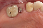 Fig 6. Occlusal view, implant showing healing cap and healthy tissue growth, Visit 3 (2 months after implant placement), Case 1.