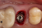 Fig 4. Occlusal view showing 4.5-mm x 11.5-mm implant just after placement, Visit 2, Case 1.