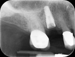 Fig 5. Periapical view, implant just after placement, Visit 2, Case 1.
