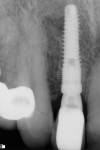 Fig 15. Periapical view, implant and stock abutment with cement-retained restoration, position No. 7 (Visit 4), placed 6 months after implant placement, Case 2. Note bone fill on distal aspect of implant.
