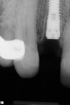 Fig 14. Radiograph just after placement of implant showing implant–alveolus gap approximately 1 mm wide and 5 mm deep, Visit 2, Case 2.