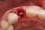 Fig 13. Occlusal view showing 3.8-mm x 16-mm implant just after placement, position No. 7, Visit 2, Case 2.