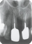 Fig 20. Preoperative periapical radiograph, PFM crowns on teeth Nos. 8 and 9 showing endodontic treatment, periapical pathology, Visit 1, Case 3.