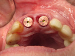 Fig 22. Incisal view of the two implants with 5-mm healing covers, Visit 2, Case 3.