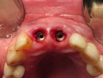 Fig 21. Incisal view, two 4.5-mm x 13-mm tapered implants just after placement in position Nos. 8 and 9, Visit 2, Case 3.