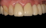 Fig 19. Preoperative photograph, PFM crowns on teeth Nos. 8 and 9, Case 3.