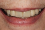 Fig 30. Smile view, observed at 3-year follow-up, Case 3.