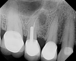 Fig 31. Preoperative periapical view showing endodontic treatment, extensive periapical pathology, and resorption, tooth No. 4, Case 4.