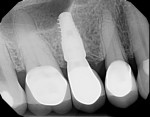 Fig 40. Periapical view, 3 years postoperatively, showing good osseointegration and favorable alveolar bone levels, Case 4.