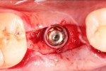 Fig 42. Occlusal view, immediately after placement of 5.5-mm x 11.5-mm implant and healing abutment, Visit 2, Case 5.