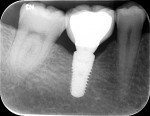 Fig 50. Periapical view, final screw-retained PFM crown, position No. 30, extraorally cemented to stock abutment, implant, 18-month follow-up, Visit 7, Case 5.