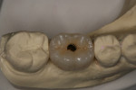 Fig 46. Laboratory model showing PFM crown with screw hole in occlusal surface, seated on stock abutment, Case 5.