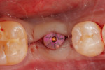 Fig 43. Closure of surgical site after placement of implant and healing abutment, Visit 2, Case 5.