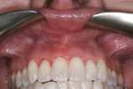 Fig. 2 Preoperative intraoral view shows zone of attached gingival and mucosal tissues.