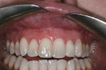 Fig. 7 Wound site shows complete healing at 6 months with minimal scarring at the mucogingival junction.