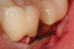 Fig. 1 Root caries below the crown margin on the mesial root surface of tooth No. 18 has been initially instrumented with a 330 carbide pear-shaped bur to establish an outline form with margins on healthy dentin.