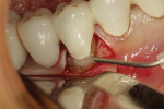 Fig. 5 Placement of restorative material in a submarginal preparation on the buccal root surface of tooth No. 28 after removal of caries from the crown margin.