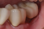 Fig. 4 The 3-year postoperative view of the restoration on the mesial tooth surface of tooth No. 18.