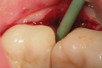 Fig. 2 A round polymer bur is shown removing the infected dentin from the carious lesion. Once the bur stops cutting, instrumentation is complete, and the cavity is ready to be restored.