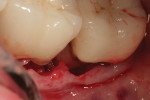 Fig. 3 Shows the cavity preparation in the mesial root surface of tooth No. 18 after placement of restorative material prior to suturing the flap back to place.