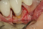Fig. 6 Shows completion of the restoration in the buccal surface of tooth No. 28 after finishing with a 30-fluted composite carbide-finishing bur and prior to suturing the flap back to place.