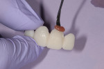 Fig. 6 Adding Beauti l II Gingival (shade G-Br) to a bis-Acryl provisional framework.