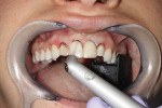 Fig. 4 The laser precisely shapes the soft and hard tissues during esthetic procedures.
