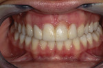 Fig. 7 The prototype smile shows the patient a better balance of pink and white.