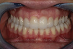 Fig. 8 The completed porcelain and bonding enhancement will positively impact the patient’s confidence and health for many years.