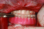 Fig. 10 An upper immediate denture is delivered at the first surgical appointment and a lower immediate denture is converted to an implant-supported prosthesis.