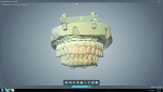 Fig. 15 The existing immediate denture is scanned into the design software.