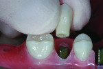 Fig. 21 Zirconia restorations are prescribed for the molars and premolars bilaterally
and lithium disilicate for the anterior teeth.