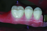 Fig. 22 Zirconia restorations are prescribed for the molars and premolars bilaterally
and lithium disilicate for the anterior teeth.