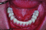 Fig. 27 The successful restorations are shown in the patient’s mouth on recall visits.