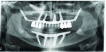 Fig. 28 The successful restorations are shown in the patient’s mouth on recall visits.