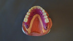 Fig. 23 Zirconia restorations are prescribed for the molars and premolars bilaterally
and lithium disilicate for the anterior teeth.